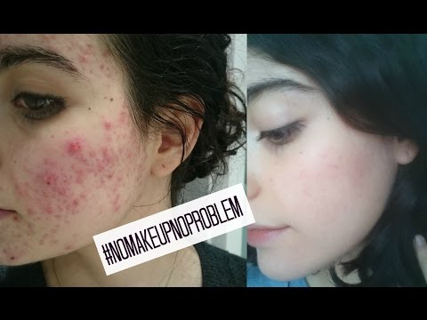 Roacutan 20 Mg Precio España