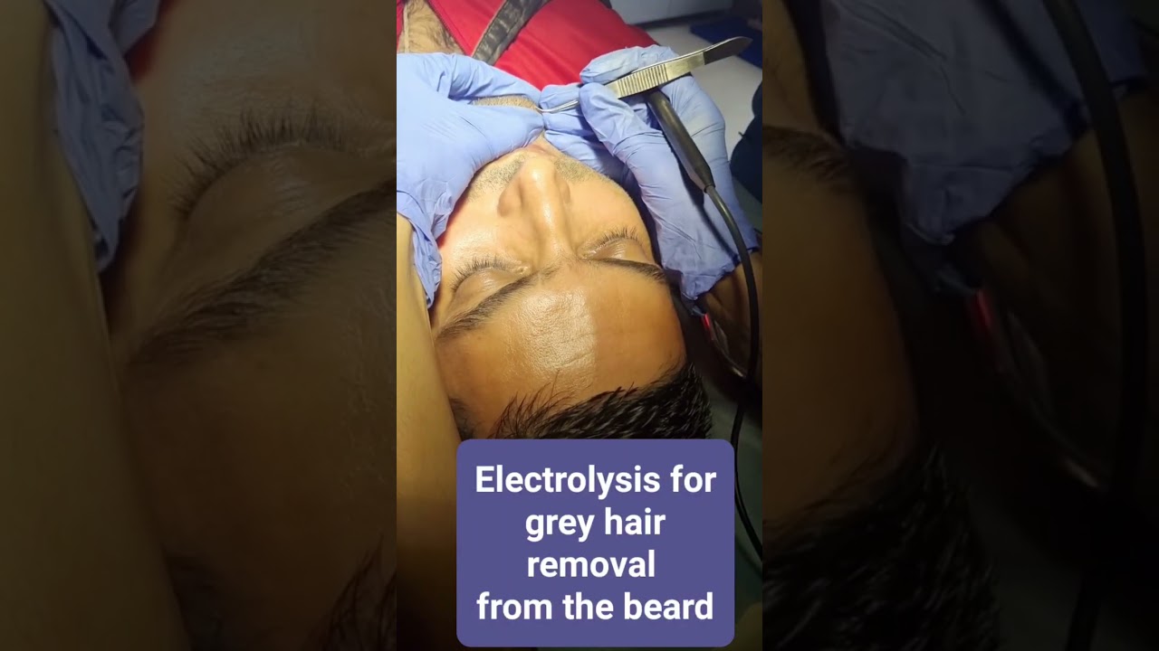 Grey Hair Removal  from the beard at Myra skin and hair solutions