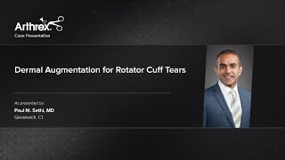 Dermal Augmentation for Rotator Cuff Tears