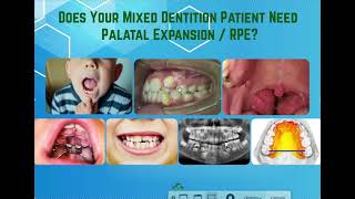 Does your Mixed-Dentition Patient Need Palatal Expansion?