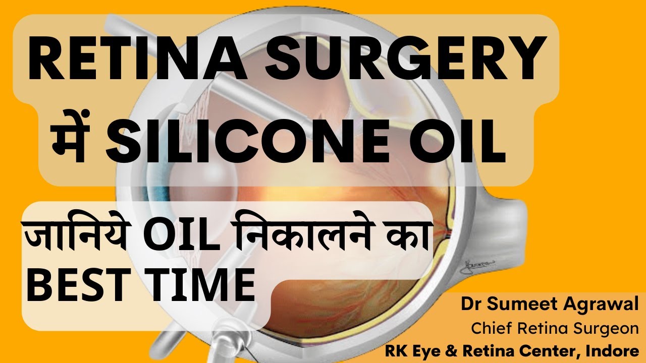 RETINA SURGERY के बाद SILICONE OIL कब निकालना चाहिए ?