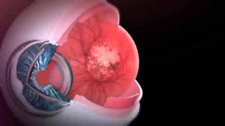 Crizal Prevencia-   A journey into eye health