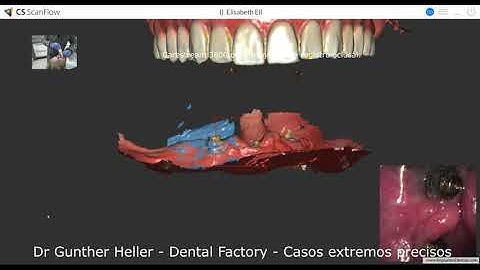 Extreme occlusal registration. Carestream with ScanFlow. Case by Dr Gunther Heller - Dexis Envista