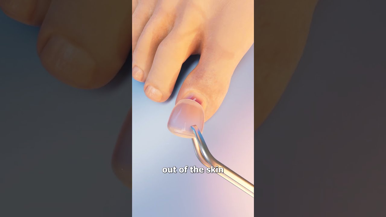 How Toenail Removal Works 