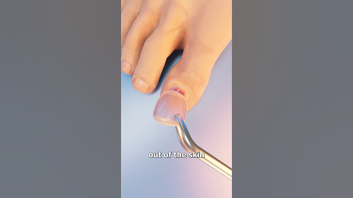 How Toenail Removal Works 😳