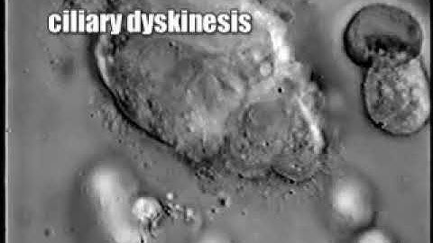 Normal Cilia vs. PCD Cilia