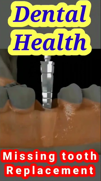 #tiktok #shorts #viral #ytshorts #durecorder #foryou #dentalimplants #instagram #hot #usa #hindi