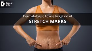Tips to get rid of stretch marks on body due to extreme weight change-Dr.Rasya Dixit|Doctors' Circle