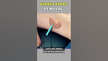 Kidney Stones Removal Surgery | 3D Animation in 60 Seconds #medicalshortsPCNLProcedure #3danimation