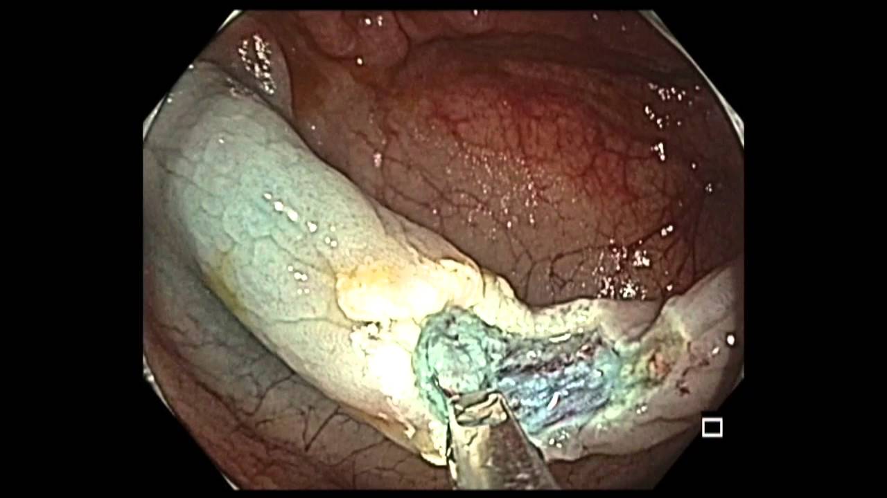 Colonoscopy: Ascending Colon Polyp Resection - YouTube