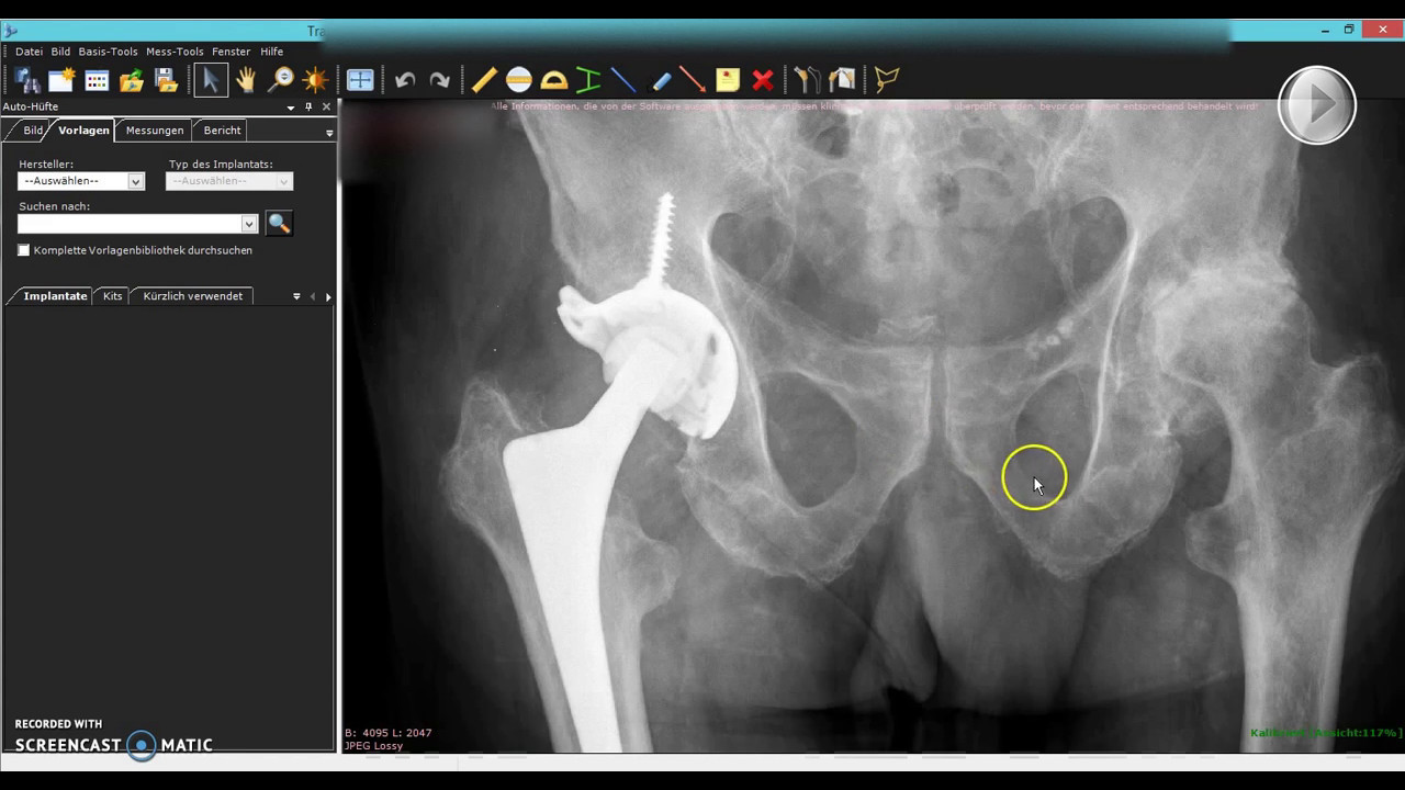 TraumaCAD Planung Hüftprothese