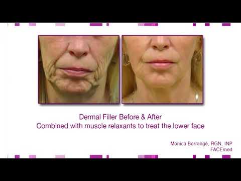 Dermal fillers before and after images FACEmed - YouTube