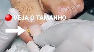 ? BEM SATISFATÓRIO unhas podologia unhaencravada