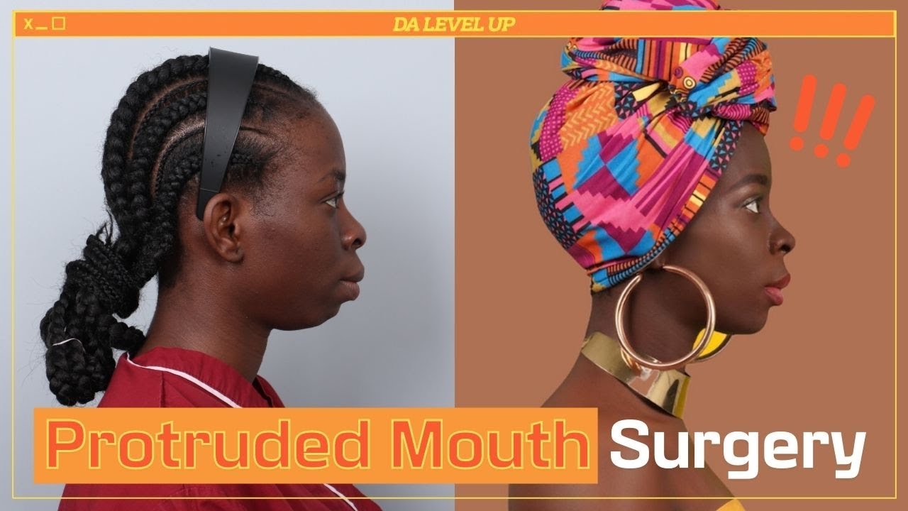 [Plastic Surgery in Korea] Outstanding Protruded Mouth Surgery result!