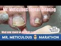 👣Satisfying Impacted Toenail Cleaning👣 #MrMeticulousMarathon