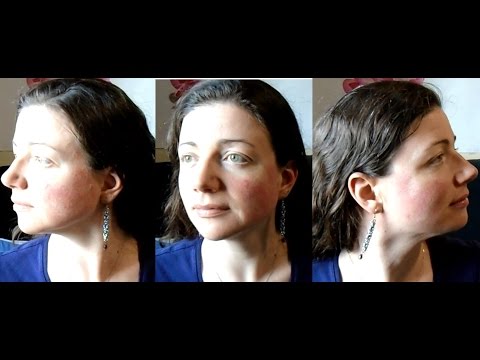 What it feels like to have rosacea - it&#;s not acne & it&#;s not a sunburn | Rosy JulieBC