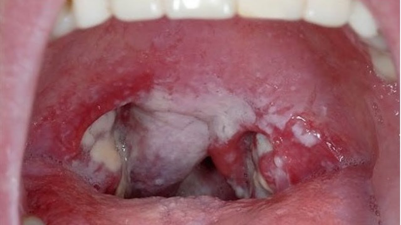throat strep Adult in