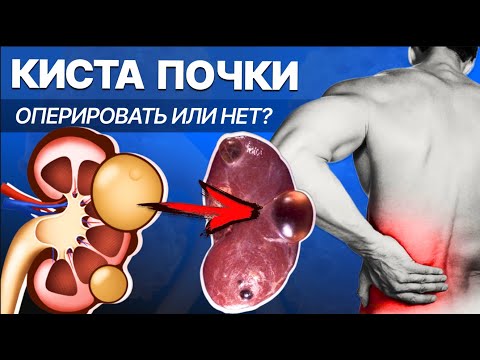 Киста почки, как лечить? Операция нужна не всем и не всегда!