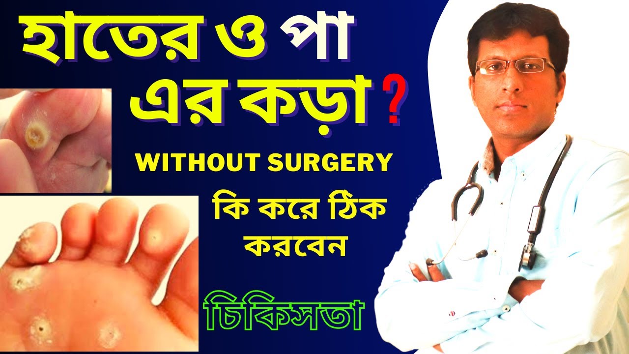 Corn কড়া কি ? Homeopathy medicine for corn homeopathy medicine for