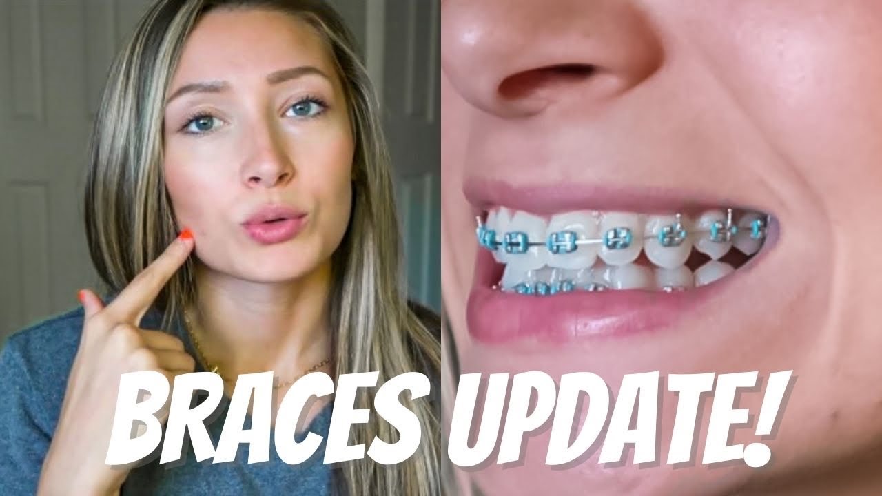 BRACES UPDATE 2021 Being an Adult with Braces YouTube