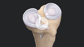 “Fix-and-Stitch” Augmented Posterior Meniscus Root Repair