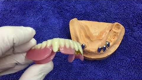 Telescopic  Crowns - replace your missing teeth Dr Bonsall, Switzerland 