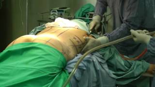 Grasa hinchazón de liposucción o
