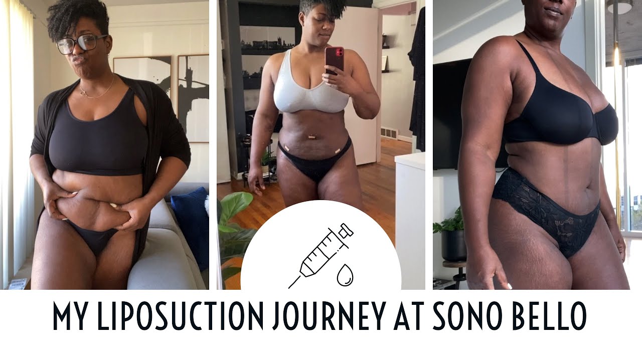 MY LIPOSUCTION JOURNEY AT SONO BELLO EXTREMELY DETAILED BEAUTYCUTRIGHT YouTube