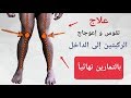 علاج تقوس و إعوجاج الركبتين | بالتمارين نهائياً