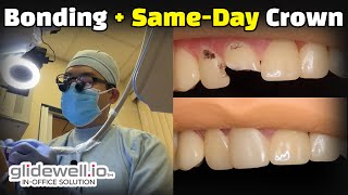Front Tooth Resin Bonding + Same-Day Crown (Glidewell.io)