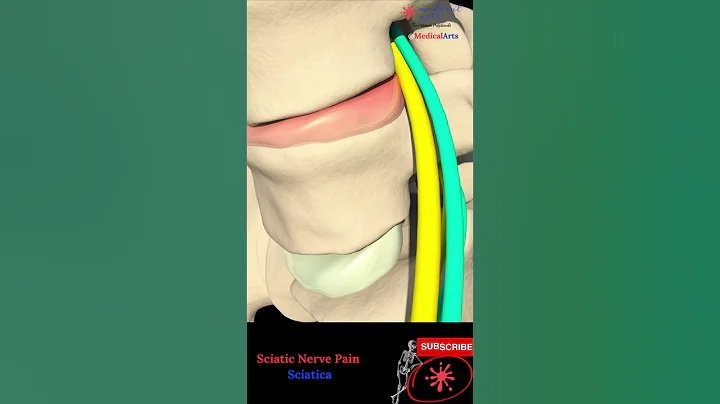 Sciatic nerve pain - Sciatica pathophysiology, causes and treatment - DayDayNews