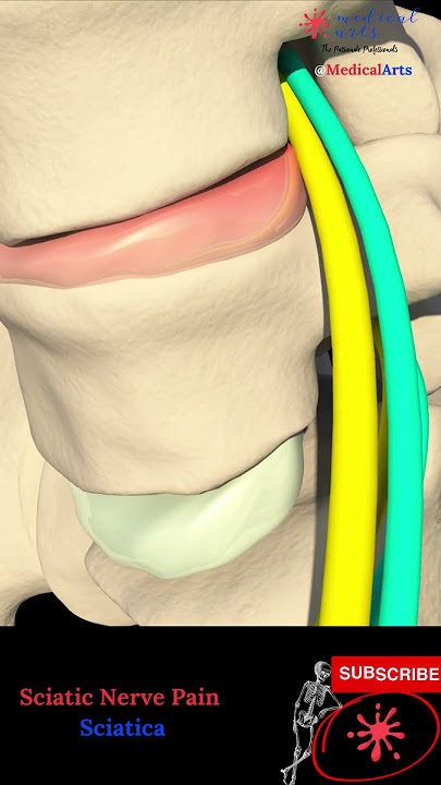 Sciatic nerve pain - Sciatica pathophysiology, causes and treatment