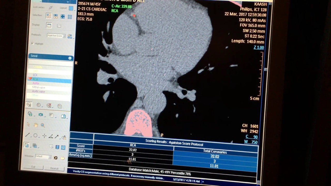 CT Cardiac Calcium Scoring YouTube