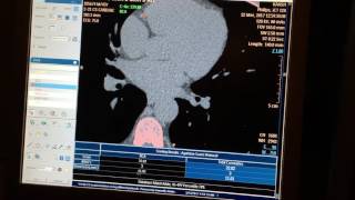 CT Cardiac  - Calcium Scoring