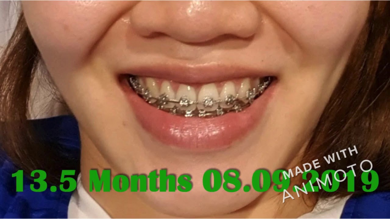 Cross bite class1 with speed metal braces power chains and 2 pins lower