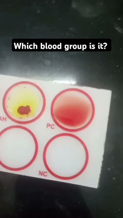 Which Blood Group Is It bloodgroup pathology youtube shorts schulterfreund-galerie