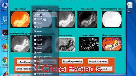 Retinal Disease Screening Through Local Binary Patterns - 1Crore Projects