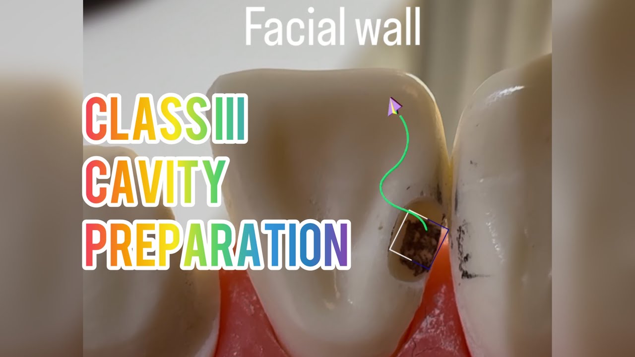  Class III cavity preparation | Dr.Dentique-hub