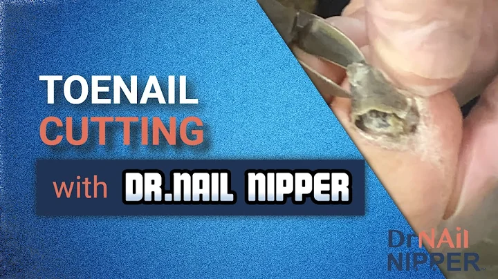 Toenail Cutting with Dr Nail Nipper on Instagram a...