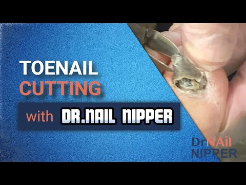 Κοπή Toenail με τον Dr Nail Nipper στο Instagram και το IGTV; (2020)