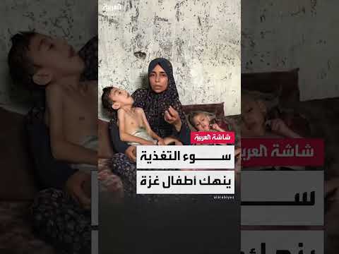 سوء التغذية يهدد حياة أطفال غزة وتدهور الأوضاع الصحية