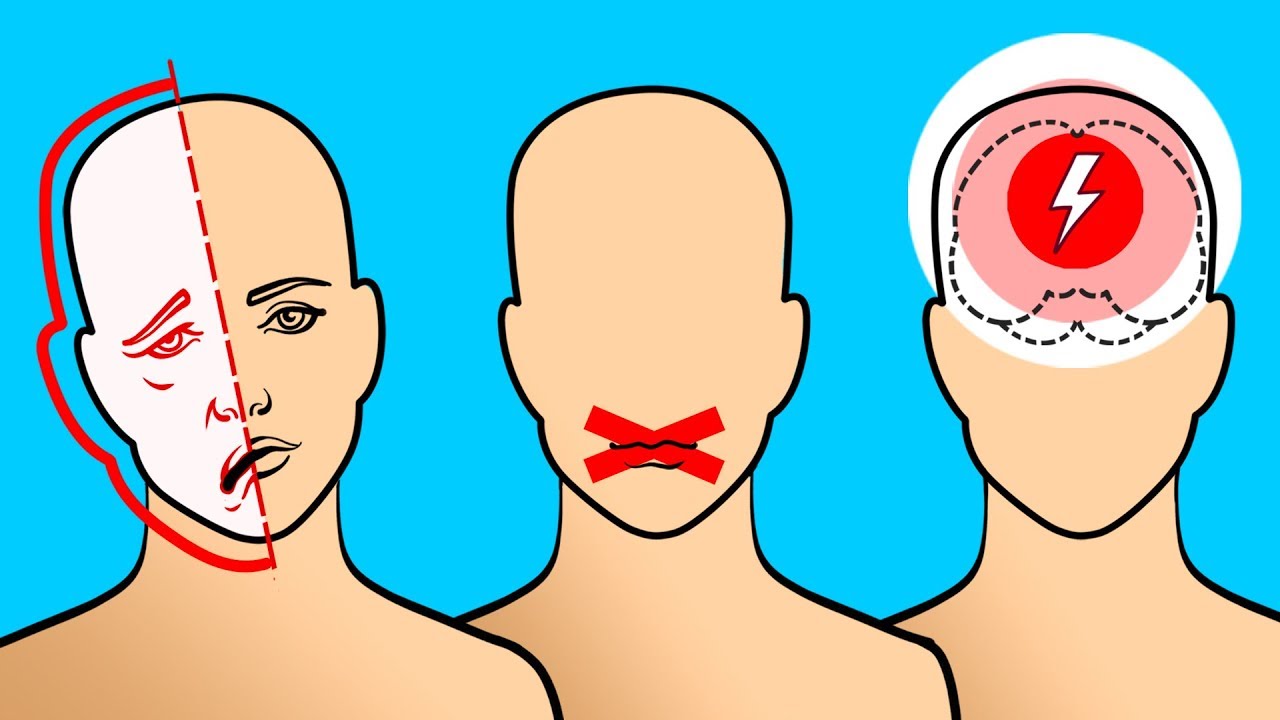 que es un derrame cerebral y sus sintomas
