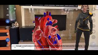 Cardiac Procedure  - Mitral Valve Replacement with EON AI Assistant