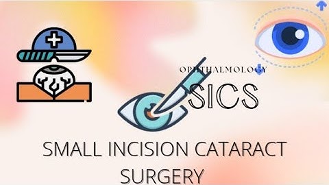 Steps of sics/SMALL INCISION CATARACT SURGERY/Hand written notes/opthalmology