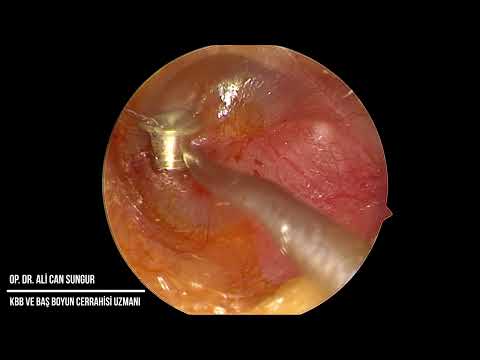 Kulak Tüpü Ameliyatı