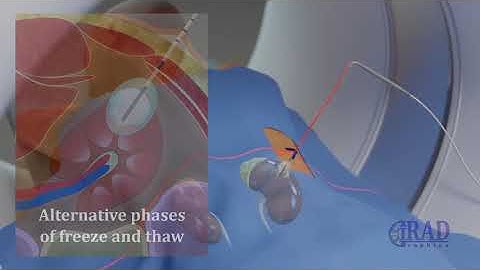 Renal Tumor Ablation (CT guided Cryoablation of kidney Tumor)