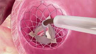 Evolut® Procedure for Aortic Stenosis Heart Valve Condition