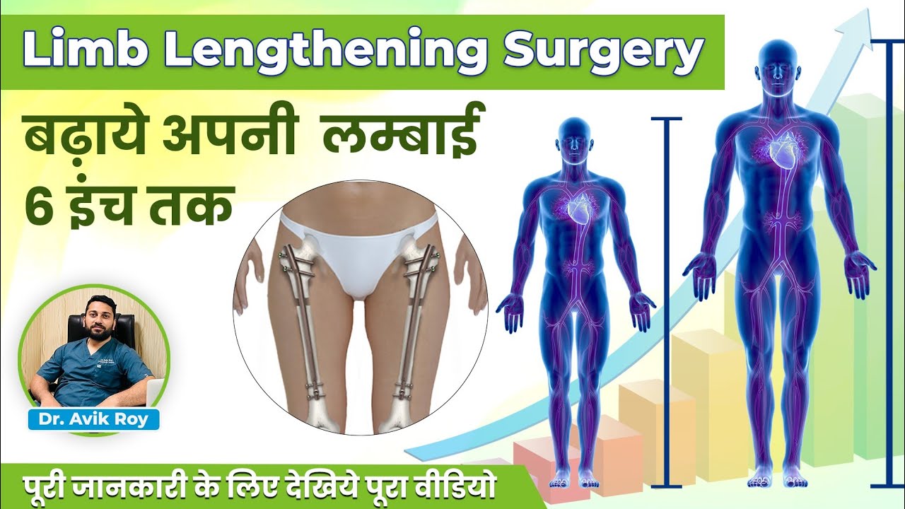 Limb lengthening procedure. How to increase your height after 18.