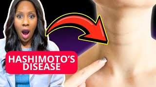 WHAT IS HASHIMOTO’S DISEASE? A Doctor Explains 