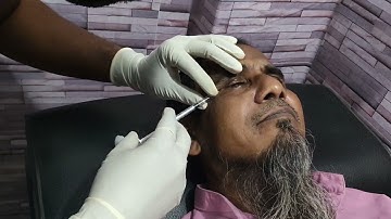 Botulinum toxin injection for Blepharospasm